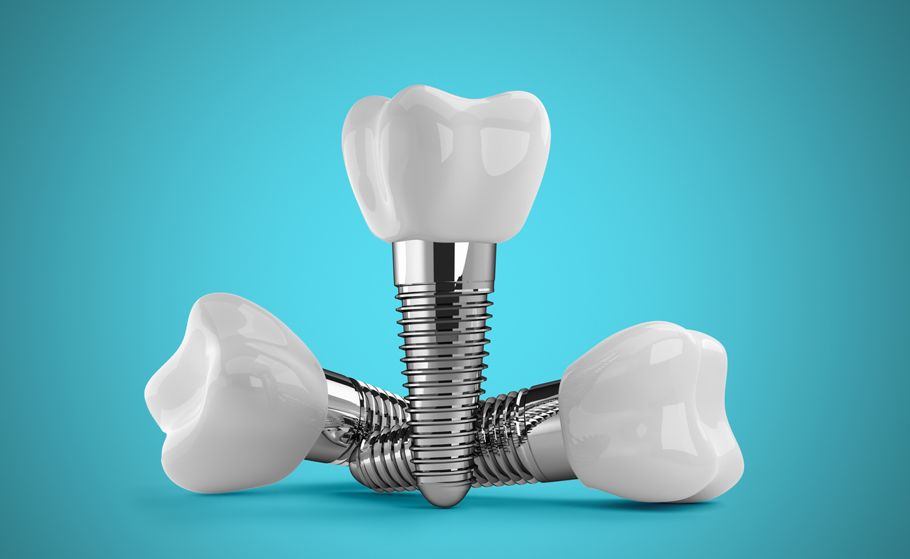 considering dental implants