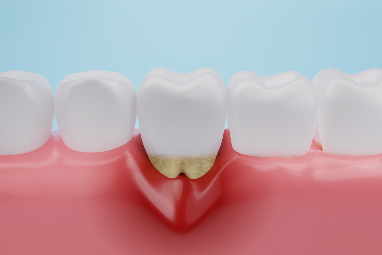 Gingival Recession