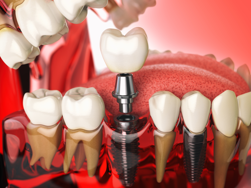 caring for dental implants