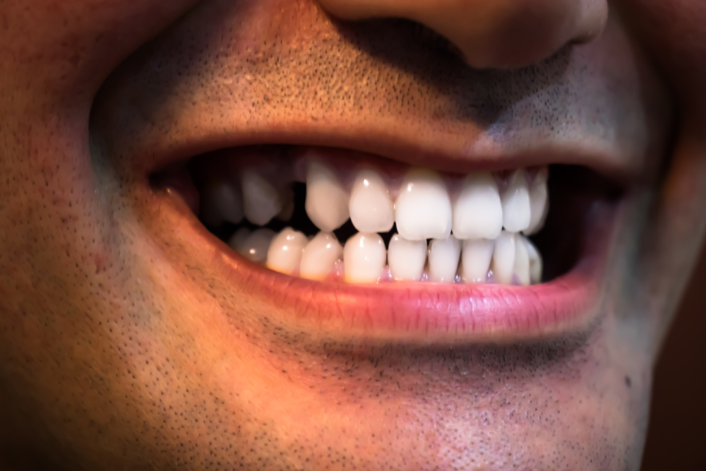 missing tooth health risk